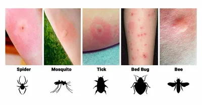 Фото аллергической реакции на укус комара