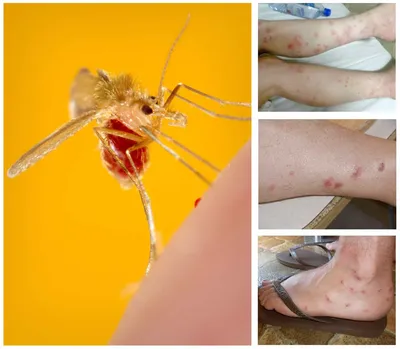 Фото аллергической реакции на укус комара для скачивания