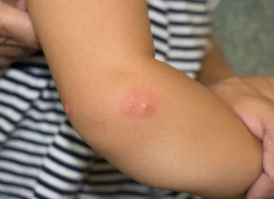 Фото аллергической реакции на укус комара: выберите размер изображения