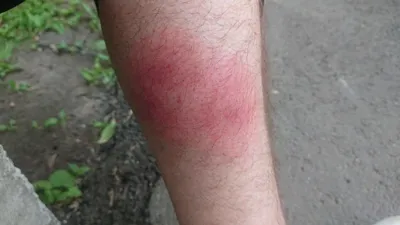 Фото аллергической реакции на укус комара: скачать в JPG