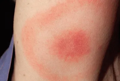 Фото аллергической реакции на укус комара: полезная информация