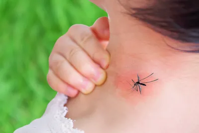 Фото аллергической реакции на укус комара: как предотвратить