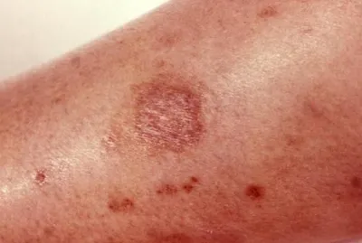 Фото аллергической реакции на укус комара: как избежать аллергии