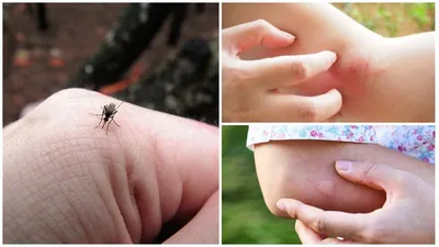 Фото аллергической реакции на укус комара: советы по уходу за кожей