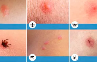 Аллергическая реакция на укус комара: фотографии и интересные факты