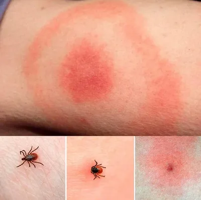 Фото аллергической реакции на укус комара: узнайте больше