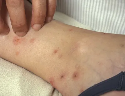 Аллергическая реакция на укус комара: фотографии и информация