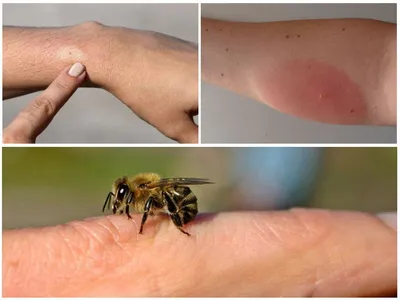 Фотографии аллергической реакции на укус комара: узнайте больше