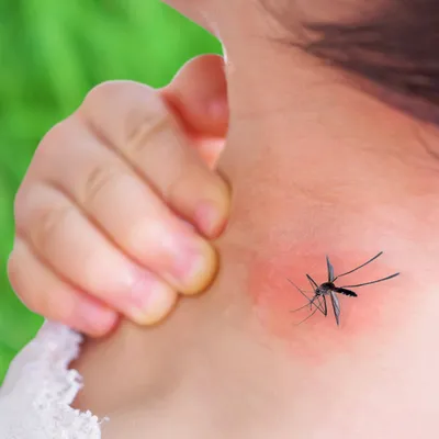 Укус комара и аллергия: фото и подробности