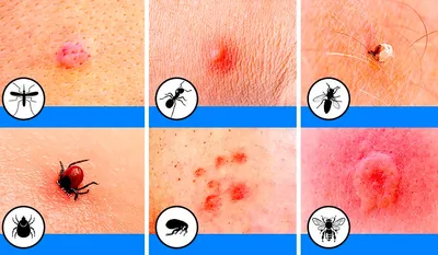 Аллергическая реакция на укус комара: фотографии и информация