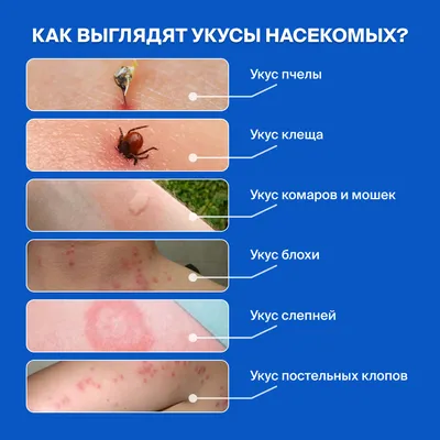 Фото аллергии на укус комара у ребенка: качественные фотографии для скачивания