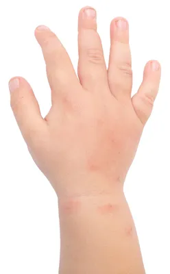 Фото аллергии на укус комара у ребенка: скачать бесплатно в разных форматах
