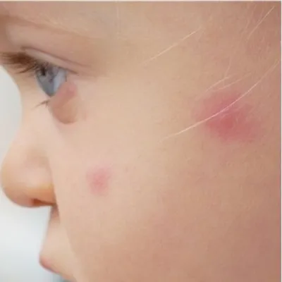 Фото аллергии на укус комара у ребенка: новые фотографии для просмотра
