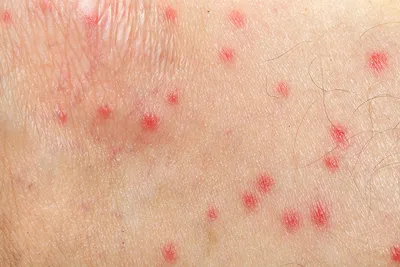 Фото аллергии на укус комара у ребенка: лучшие фото для скачивания