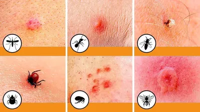 Фото аллергии на укус комара у ребенка: скачать бесплатно в разрешении 4K
