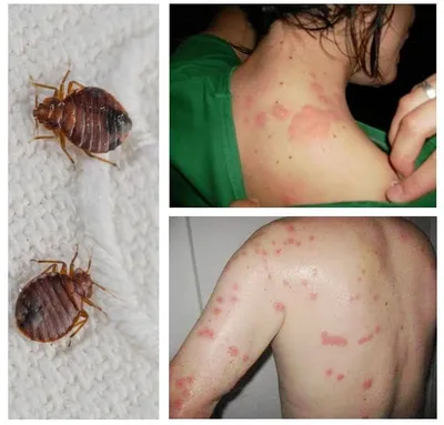 Фото аллергии на укус комара у ребенка: скачать изображение в формате PNG