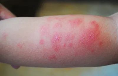 Фото аллергии на укус комара у ребенка: выберите размер изображения для скачивания