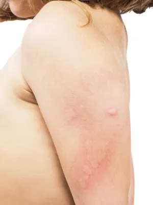 Фото аллергии на укус комара у ребенка: скачать бесплатно в разных разрешениях