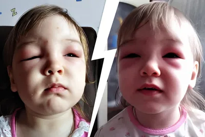 Аллергия на укус комара у ребенка: фото и причины
