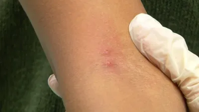 Как выглядит аллергическая реакция на укус комара у ребенка: фото
