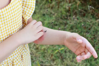 Фотографии аллергии на укус комара у детей: симптомы и лечение