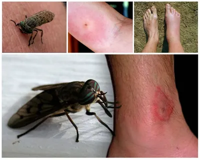 Как выглядит аллергия на укус комара у ребенка: фото и симптомы