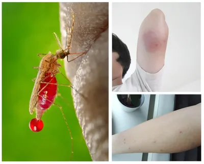 Фотографии аллергической реакции на укус комара у детей: как помочь ребенку