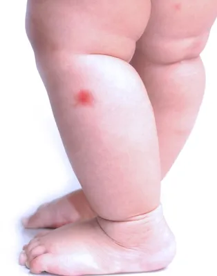 Аллергия на укус комара у ребенка фотографии