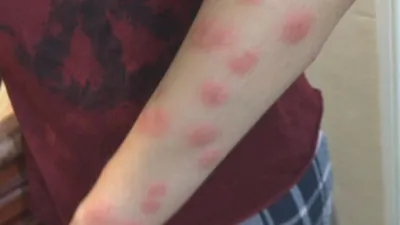 Аллергия на укус комара у ребенка: фото и советы для родителей