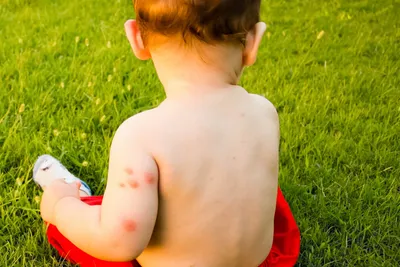 Фотографии аллергии на укус комара у детей: причины и лечение