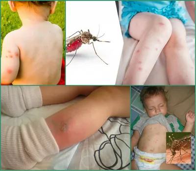 Фотографии аллергической реакции на укус комара у детей: что делать