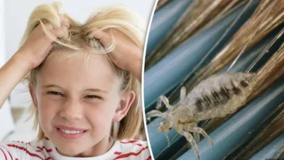 Как выглядит аллергия на укус комара у ребенка: фото и лечение