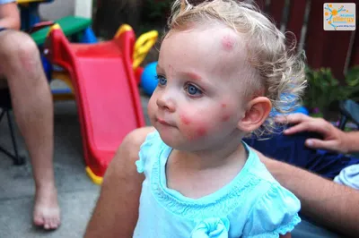 Аллергия на укус комара у ребенка: фото и советы по профилактике