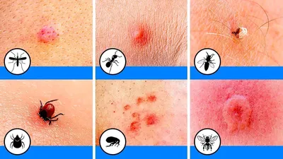 Фотографии аллергической реакции на укус комара у детей: что нужно знать