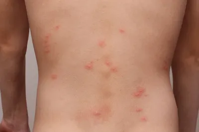 Фотография аллергии на укус комара у ребенка