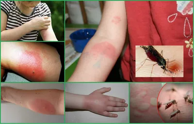 Арт аллергии на укус комара у ребенка
