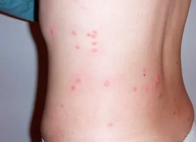 Фото аллергии на укус комара у ребенка в хорошем качестве