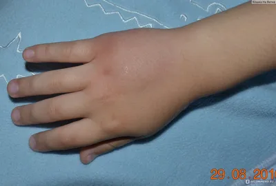 Фото аллергии на укус комара у ребенка в формате jpg