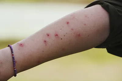 Аллергия на укусы комаров и мошек: фотографии и средства от зуда