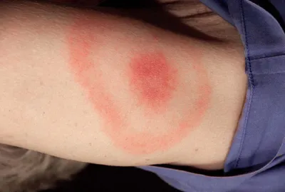 Удивительные фотографии аллергии на укусы муравьев
