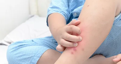 Аллергия на укусы муравьев: фото и советы по первой помощи