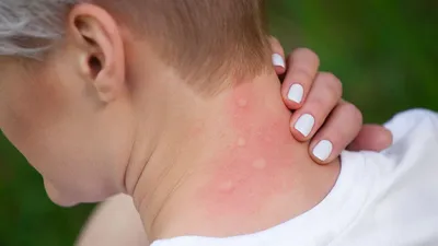 Аллергия от укуса комара  фото