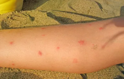 Аллергия от укуса комара фотографии