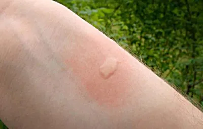 Аллергия в виде укусов комара  фото
