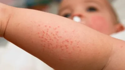 Аллергическая реакция на укусы комаров: фото и информация