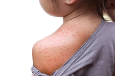 Фотографии аллергии на комариные укусы: как выглядят их последствия
