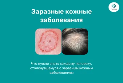 Гнойничковые заболевания: Фотография гнойничковых высыпаний