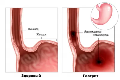 Гистиоцитоз кожи: Изображение с описанием