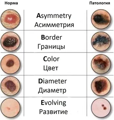 Чесотка: Изображение болезни в JPG