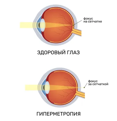 Изображение: Фотография болезней век у человека в WebP